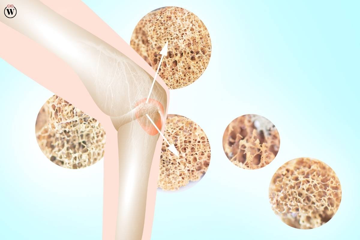 Drugs for Osteoporosis: Types, Mechanisms and Side Effects | CIO Women Magazine