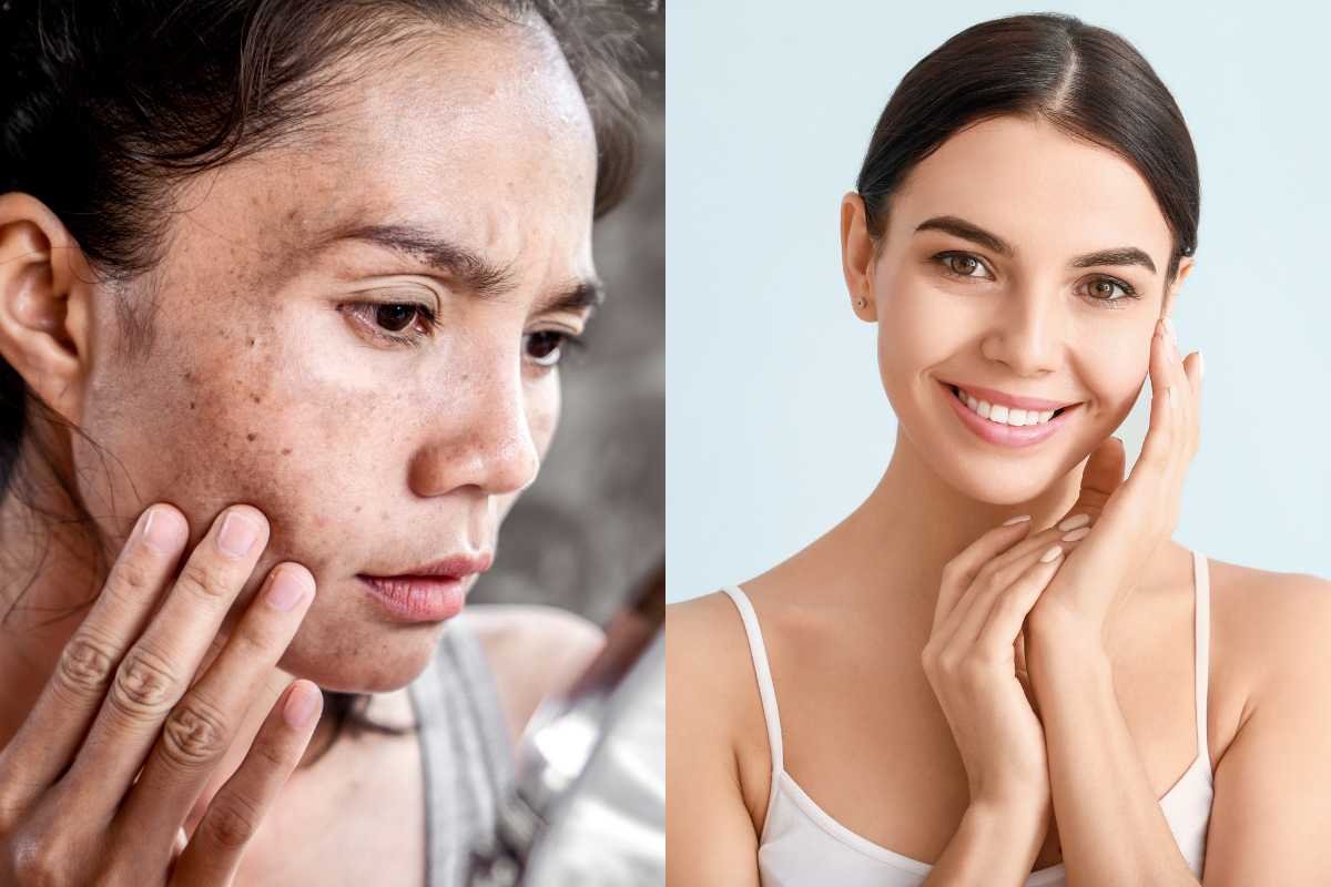 Glow Again: Easy Ways to Remove Dark Spots on Face