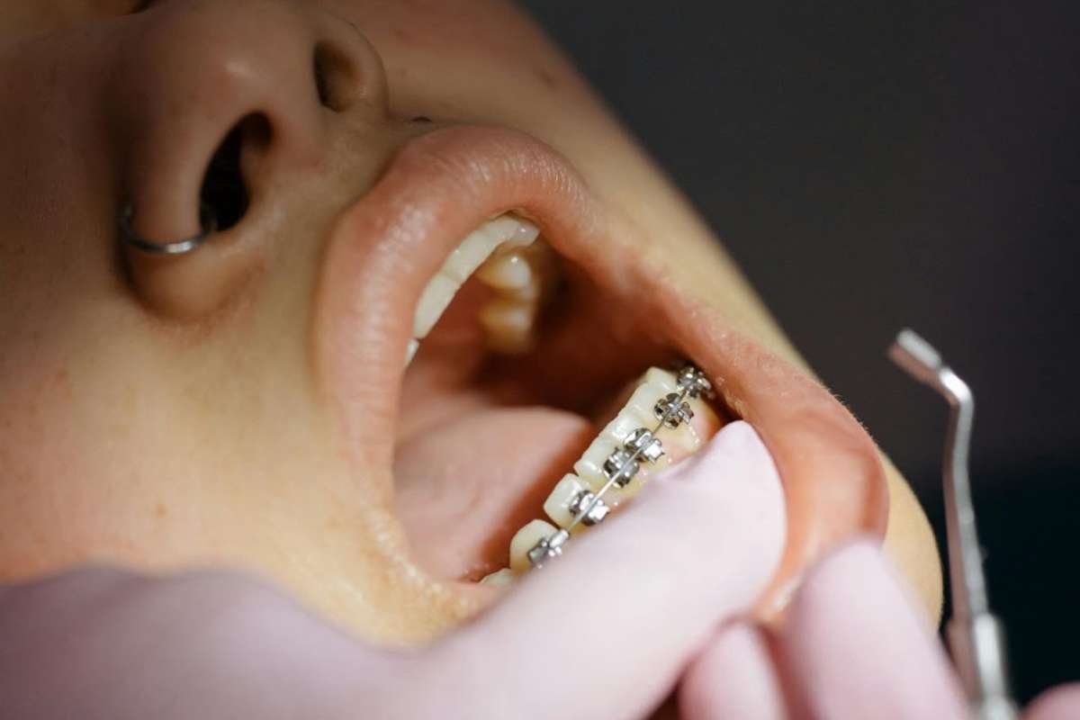 A Guide To The Different Types of Teeth Straightening | CIO Women Magazine