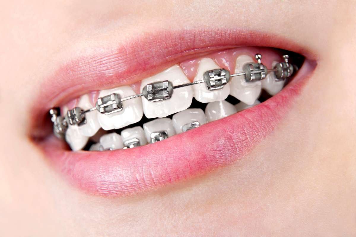 A Guide To The Different Types of Teeth Straightening | CIO Women Magazine