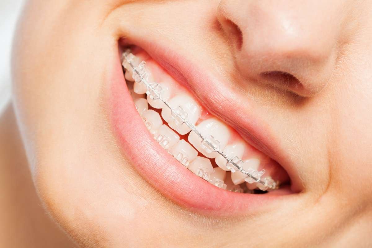 A Guide To The Different Types of Teeth Straightening | CIO Women Magazine
