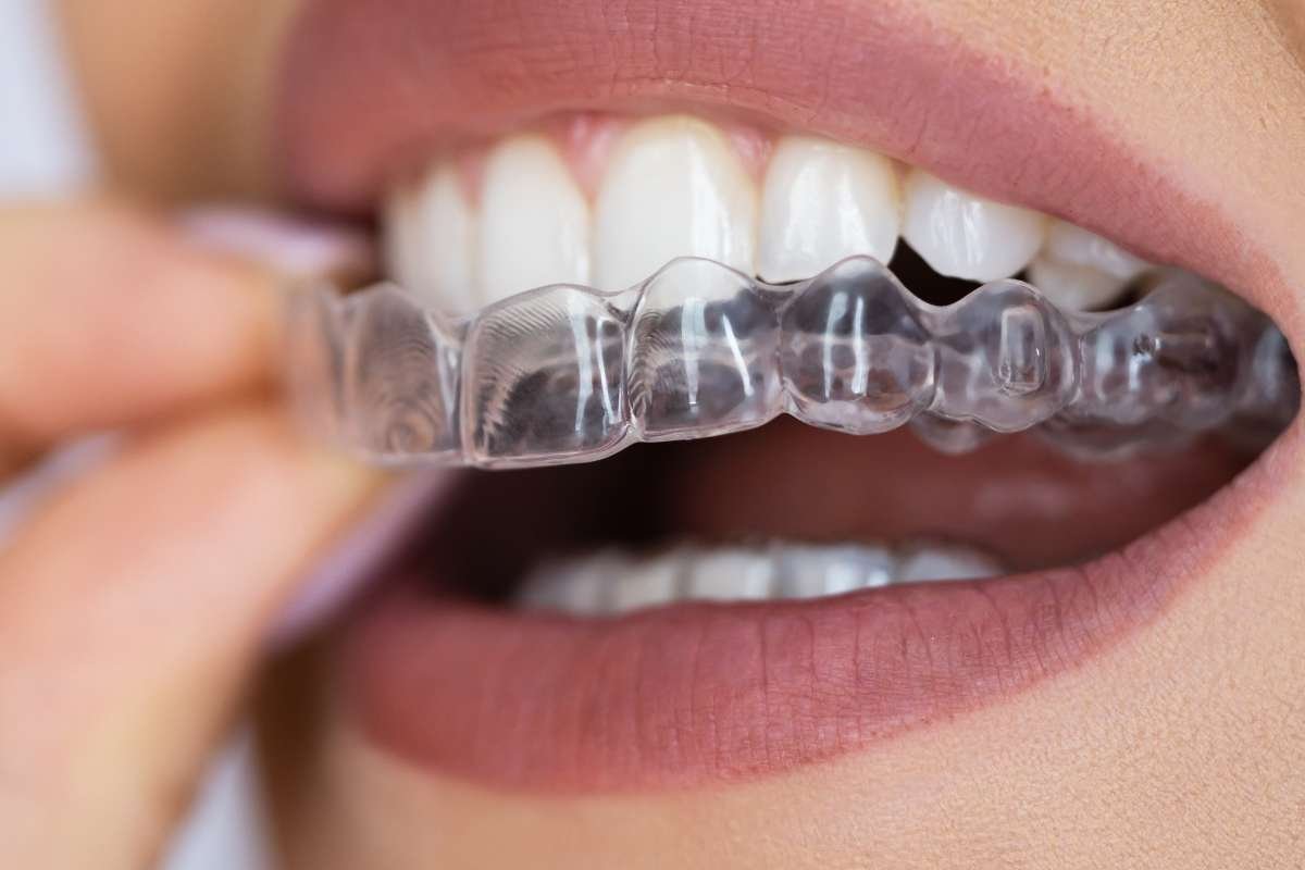 A Guide To The Different Types of Teeth Straightening | CIO Women Magazine
